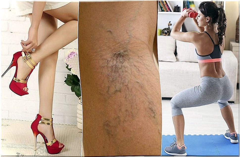 10 tips that help you avoid the appearance of varicose veins