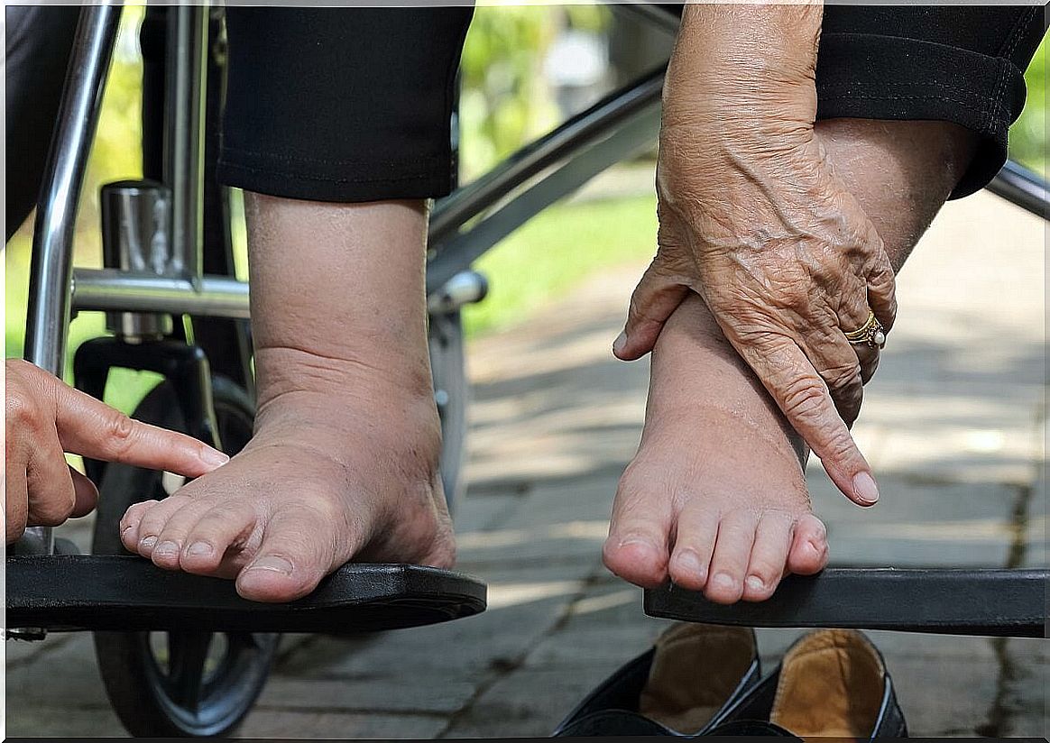 Tips for taking care of your diabetic foot during the summer