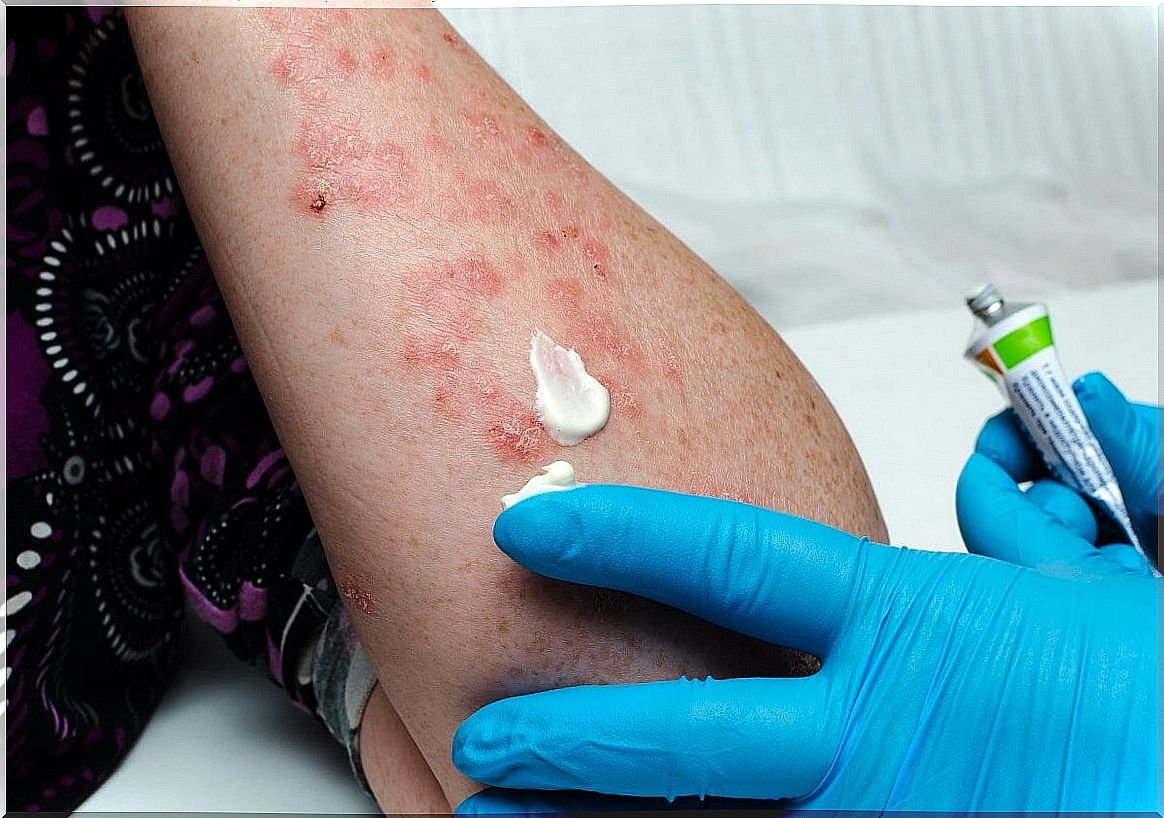 Treatment of psoriasis