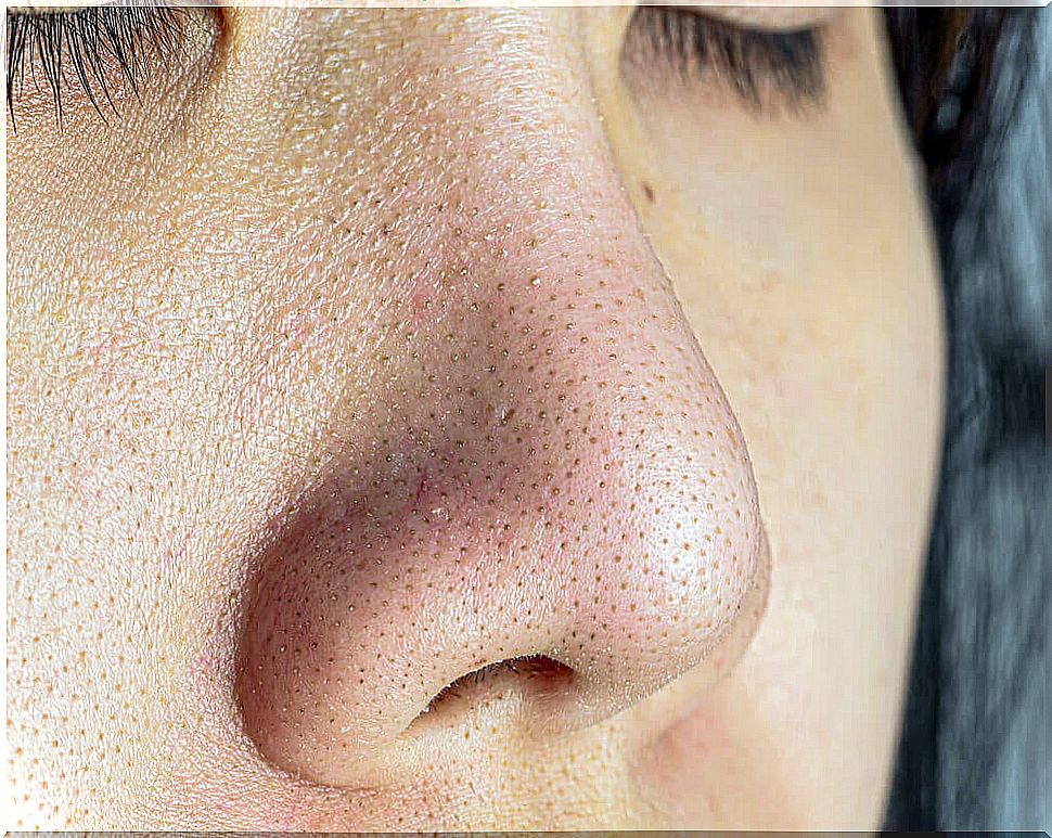Facial skin with black dots.