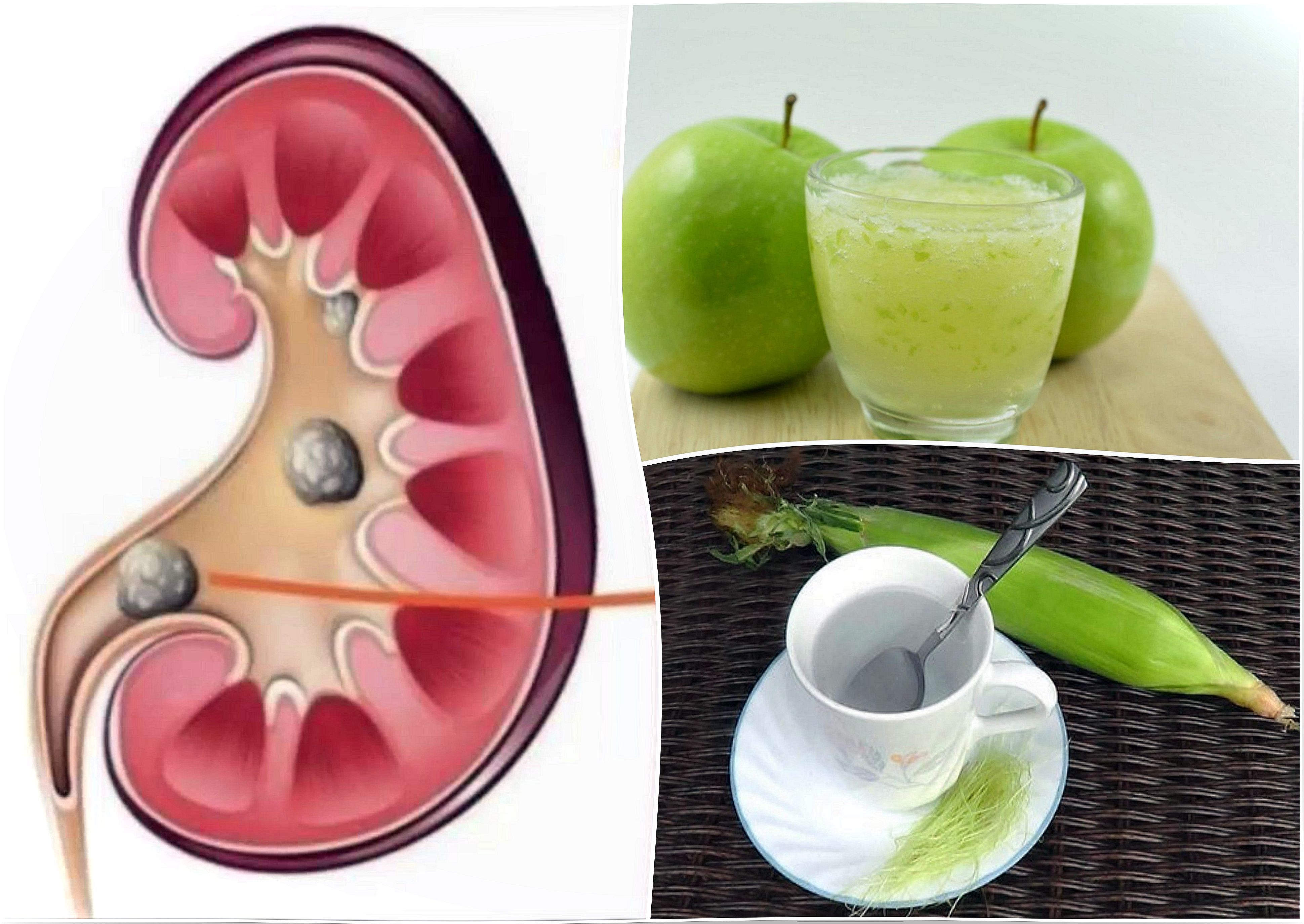 Eliminate kidney stones with 5 natural remedies