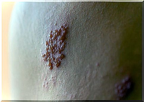 Shingles blisters on the back