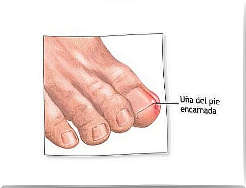 How to cut nails and prevent ingrown