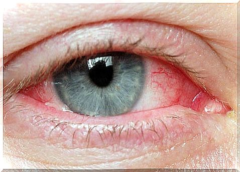 Natural tips for irritated eyes