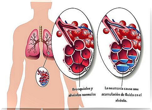 Accumulation-of-fluid-in-the-alveoli-is-pneumonia-or-pneumonia