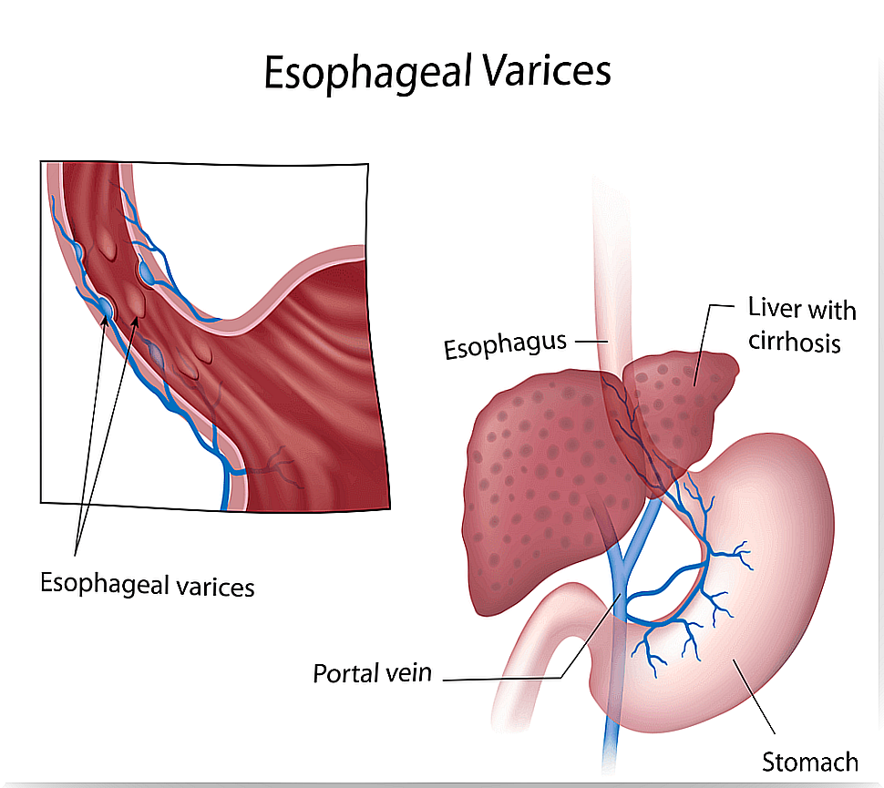 Signs and symptoms of esophageal varices