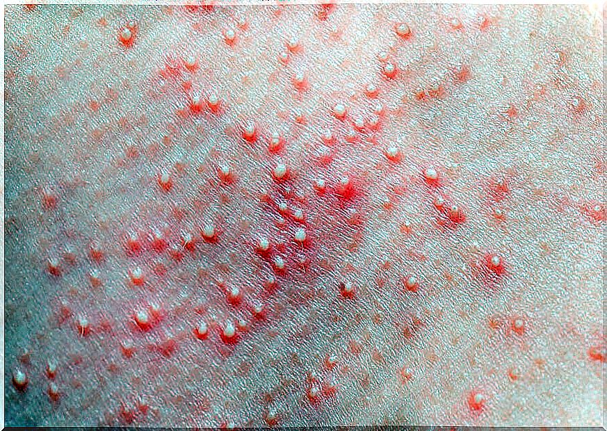 Sudamina affects the surface layer of the skin