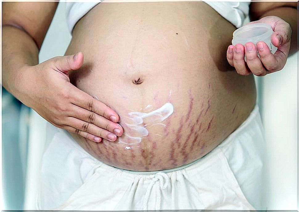 What are stretch marks?  Understand how stretch mark creams work