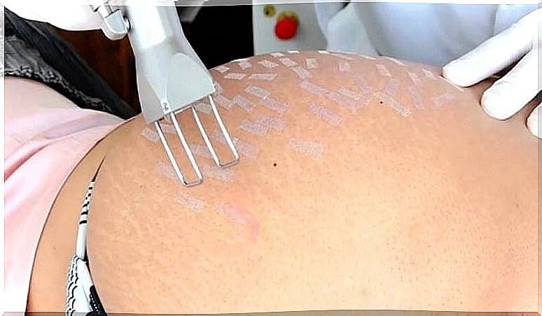 peeling-treatments-for-stretch marks